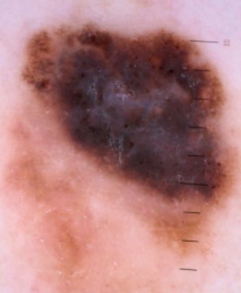 imagen de melanoma