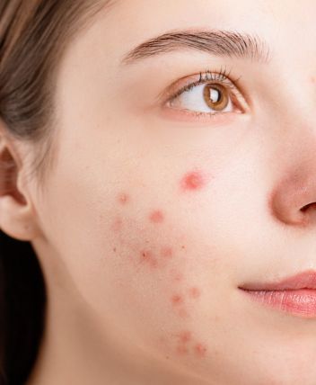 imagen de acne
