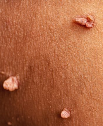 imagen de acrocordones