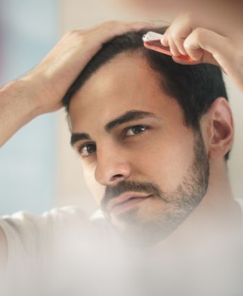 imagen de alopecia androgenética