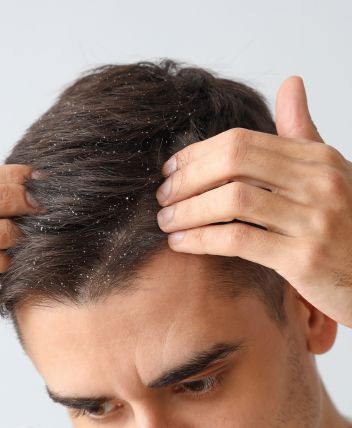 imagen de dermatitis seborreica