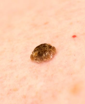 imagen de queratosis seborreica