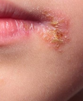 impetigo