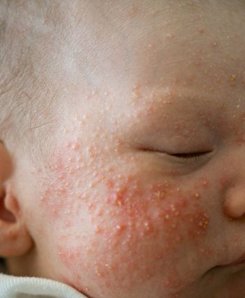 acne neonatal