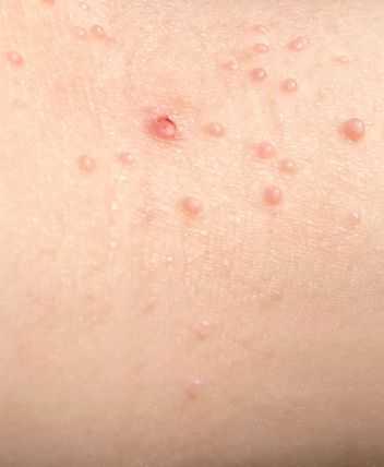 molusco contagioso