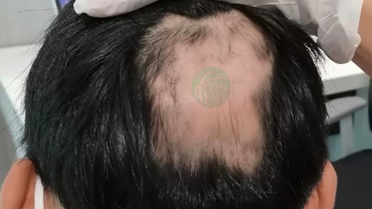alopecia areata 1