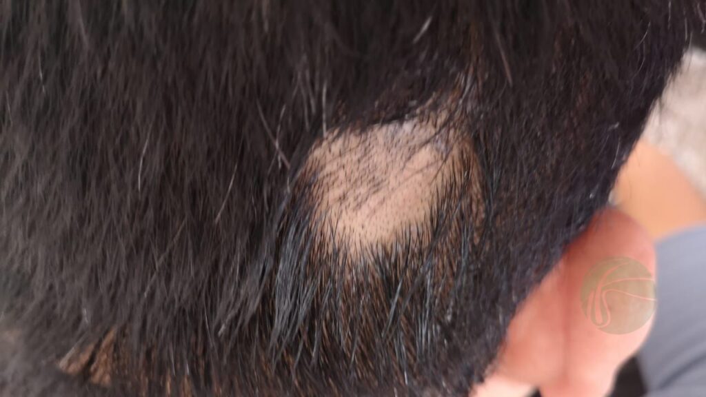 alopecia areata 3