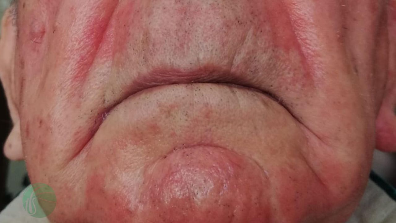 deratitis seborreica 2