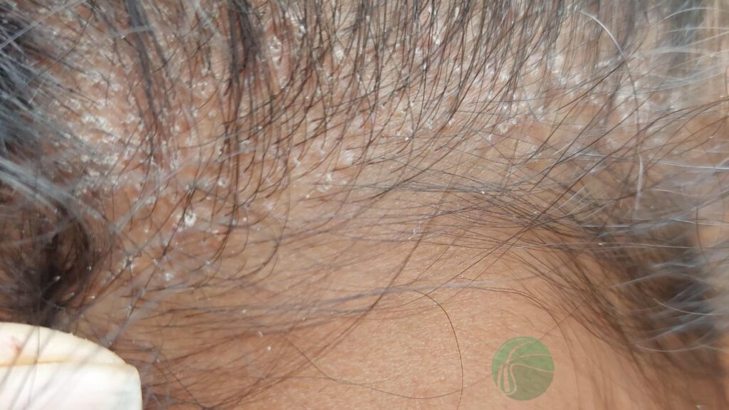 ¿Qué es la Dermatitis Seborreica? Causas, Síntomas y Tratamientos Efectivos dermatitis seborreica 1