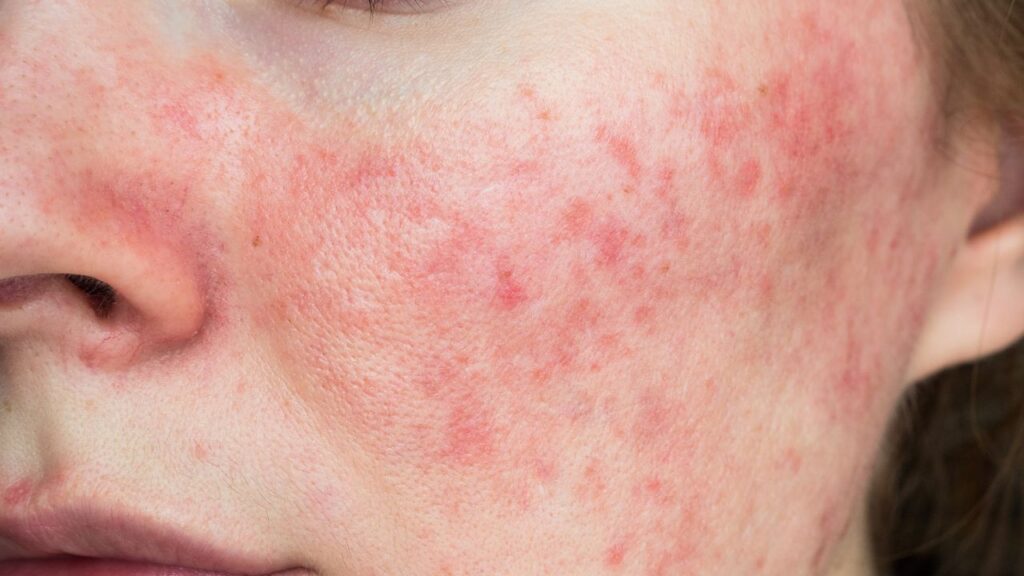 ¿Qué es la Rosácea? Causas, Síntomas y Tratamientos Efectivos rosacea 1