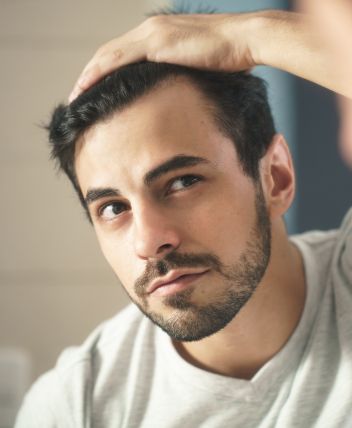 alopecia androgenetica