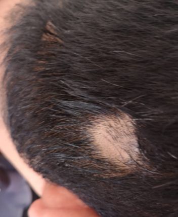 alopecia areata 2