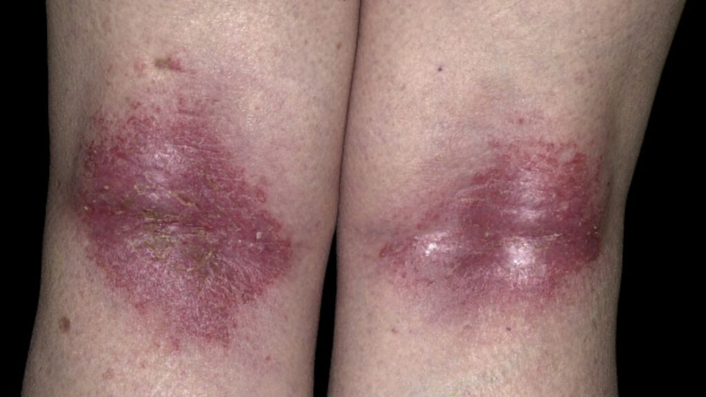 dermatitis atópica 3