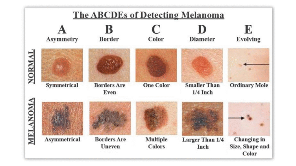 ¿Qué son los Nevos Melanocíticos y cómo diferenciar un lunar común de uno atípico? abcde