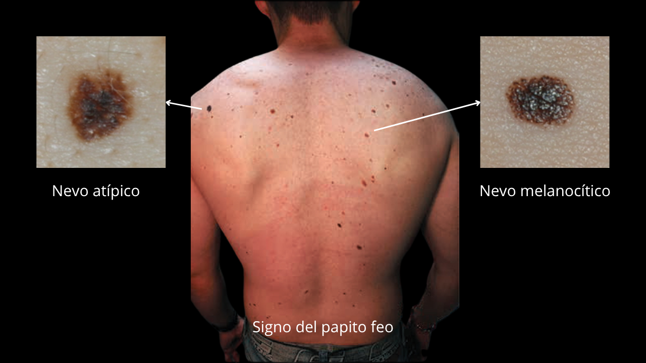 nevo atípico 1