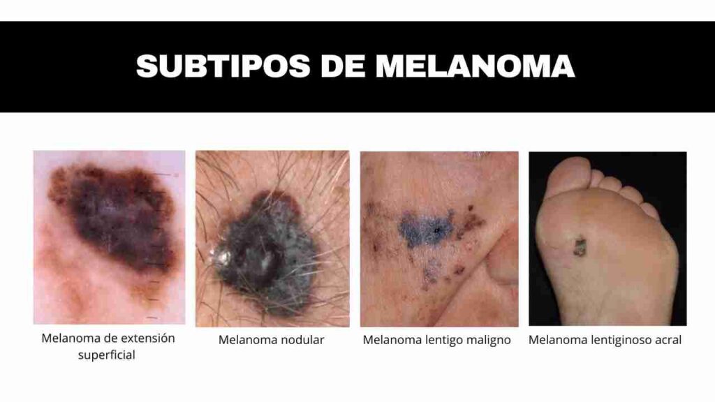 melanoma 1