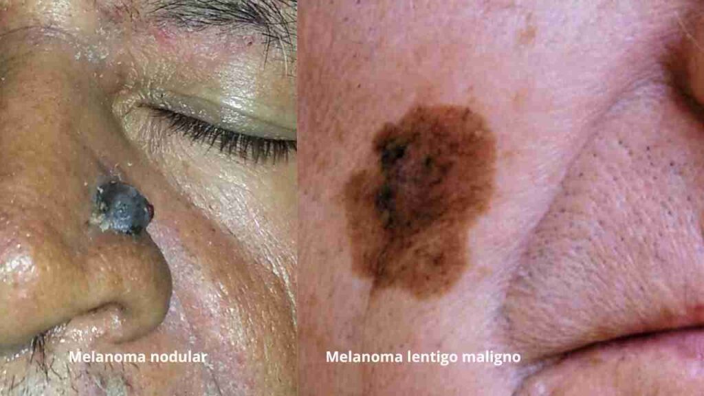 melanoma 2