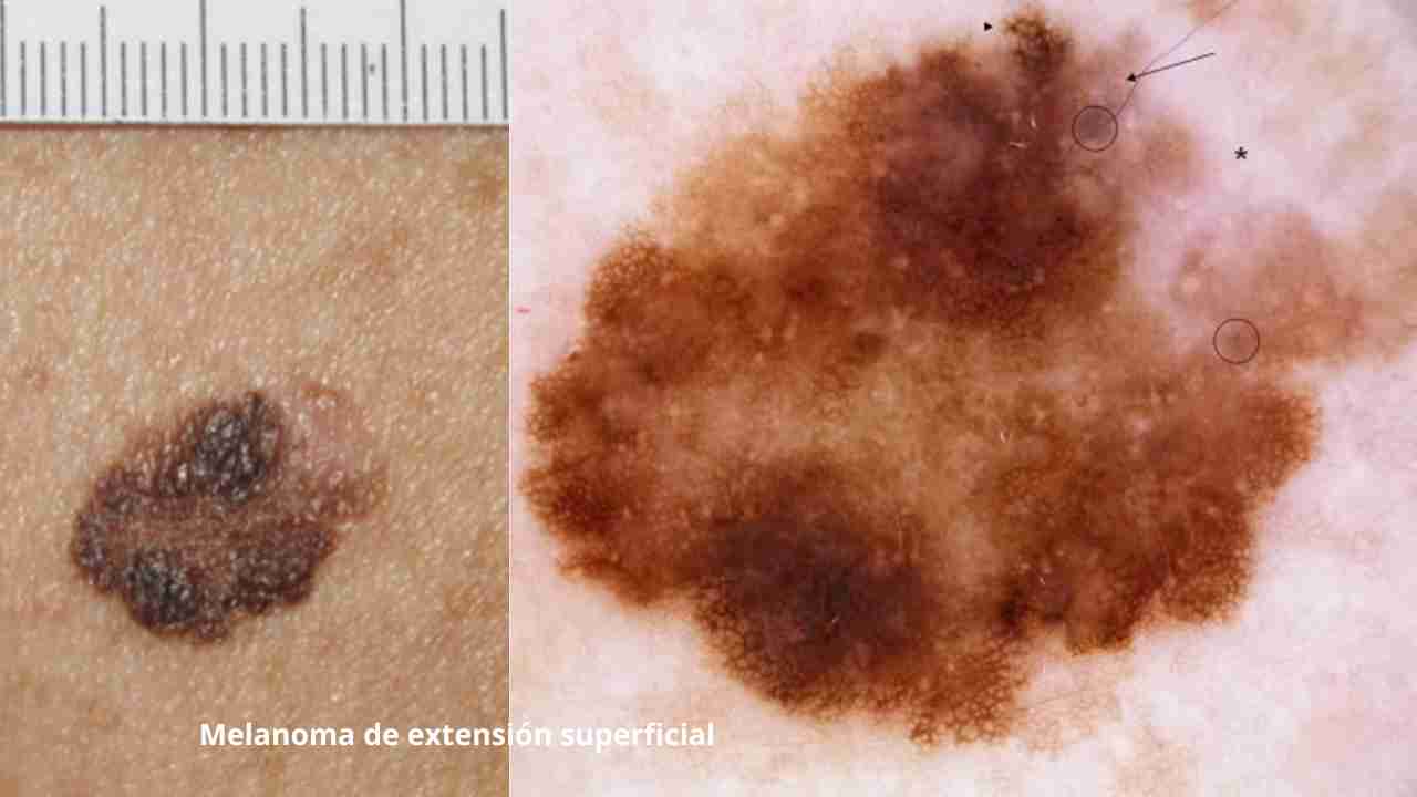 melanoma 3