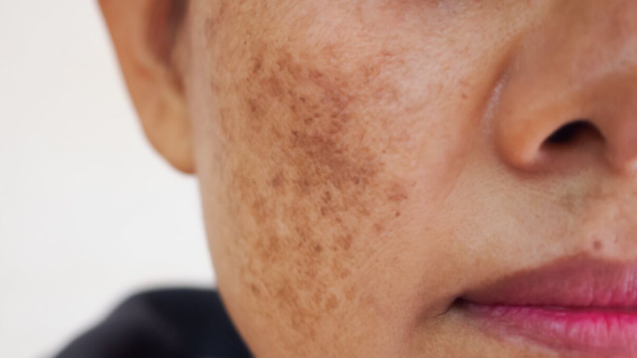 melasma 2