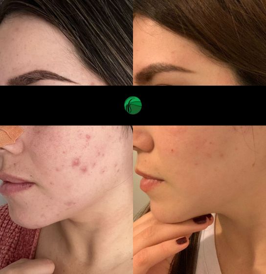 foto acné antes y despues
