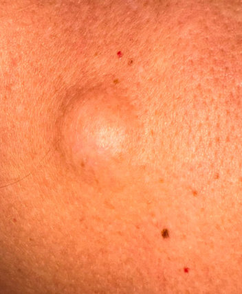 quiste epidermoide